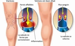 Solution efficace Contre Les Varices A La Maison 