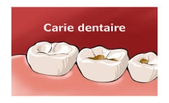 Conseils simples pour prévenir les caries