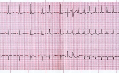 Palpitations cardiaques : astuce pour faire baisser naturellement son rythme cardiaque