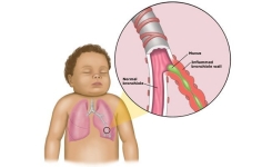 Comment moucher efficacement votre bébé pour éviter la bronchiolite.