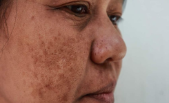 Les traitements naturels pour éliminer les taches brunes sur le visage