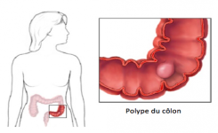 Les Symptômes de la Présence de Polypes au Colon à ne Pas Ignorer