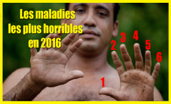 Top 6 des maladies les plus horribles en 2016 