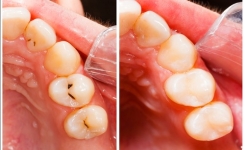 Comment guérir naturellement les caries