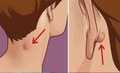 Ce que vous devez savoir si vous découvrez une enflure dans le cou ou derrière l’oreille