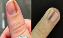 Pourquoi vous devez consulter un médecin si vous voyez des stries sur votre ongle.