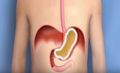 Un remèdes naturel pour soigner l’acidité, le reflux gastrique et les brûlures d’estomac