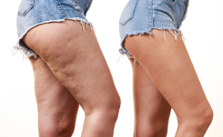 4 recettes de Grand-Mère pour se débarrasser de la cellulite sans se ruiner