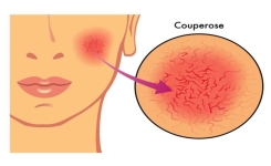 Remède naturel pour traiter la couperose ou les varices sur le visage
