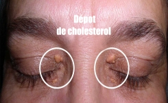 Remèdes naturels pour se débarrasser des dépôts de cholestérol autour des yeux