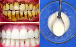 Un dentiste montre comment éliminer le tartre et blanchir les dents en 4 étapes avec cette recette maison