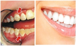 Voici comment enlever la plaque des dents en seulement 5 minutes!