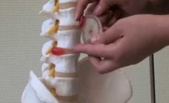 Soigner L’hernie discale sans passer par la chirurgie classique