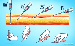 Comment faire une injection si tu n’en as jamais fait auparavant