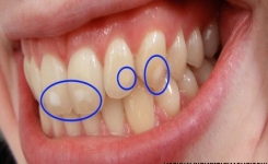 Comment se débarrasser des taches blanches sur les dents naturellement
