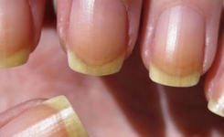 Ongles jaunis? Voici une solution naturel pour y remédier !