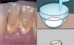 Ce bain de bouche fait maison enlève la plaque dentaire en 2 minutes