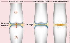 Un hydrogel intelligent pour régénérer le cartilage abîmé