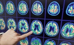 Un test pourrait détecter la maladie d'Alzheimer 20 ans avant qu'elle ne se déclare