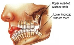 Les dents de sagesse : Voici pourquoi vous en avez besoin ! 