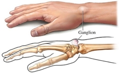 Des remèdes naturelles pour soigner le kyste Synovial !