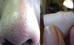 Comment se débarrasser des points noirs sur le nez rapidement chez vous