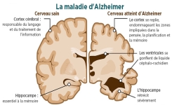 4 Choses à savoir pour ne pas avoir la maladie d’Alzheimer