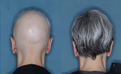 La FDA approuve un médicament contre l’alopécie qui restaure la croissance des cheveux chez de nombreux patients