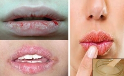 Comment Traiter des Lèvres Gercées et Irritées ?