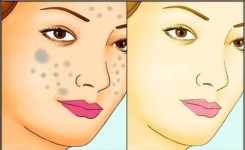 Enlever les taches brunes sur votre visage naturellement !