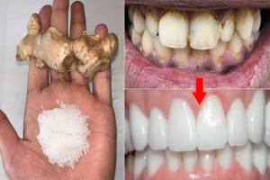 Le gingembre et le sel permettent de blanchir les dents