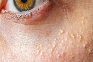 Comment éviter l’apparition des grains de milium ?