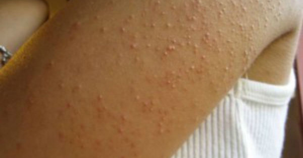 7 signes d’une intolérance au gluten que tout le monde ignore !