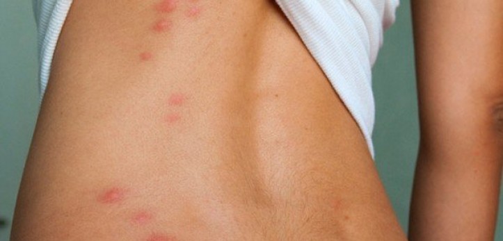 Pourquoi les moustiques s’acharnent toujours sur les mêmes personne ? On a enfin la réponse