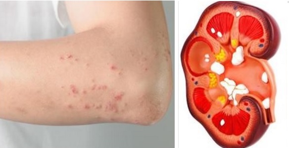 Voici les signes qui doivent vous alerter ! … Quand les reins ne fonctionnent pas bien