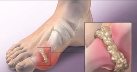 Les solutions naturelles qui soulagent les douleurs articulaires, la goutte, L’arthrose et l’arthrite
