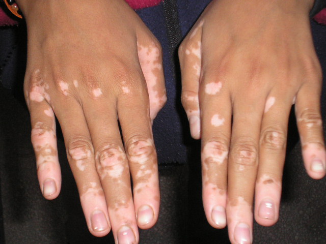 Dites adieu au vitiligo, voici un remède naturel peut vous permettre de protéger votre peau