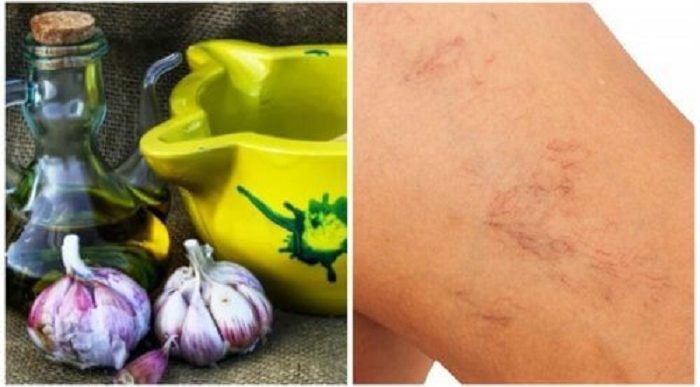 Voici comment préparé le mélange à bas d’huile d’olive pour traiter la varice et éliminer les veines d’araignées
