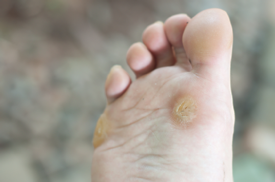 Comment éliminer les cors au pied et les verrues naturellement