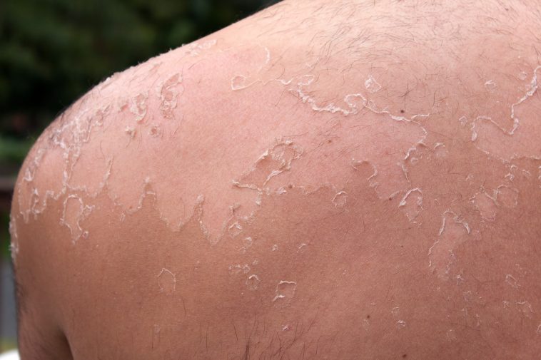 J’ai la peau qui pèle, que faire ?