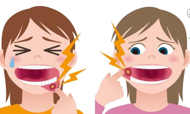 3 astuces pour vous débarrasser de vos ulcères douloureux