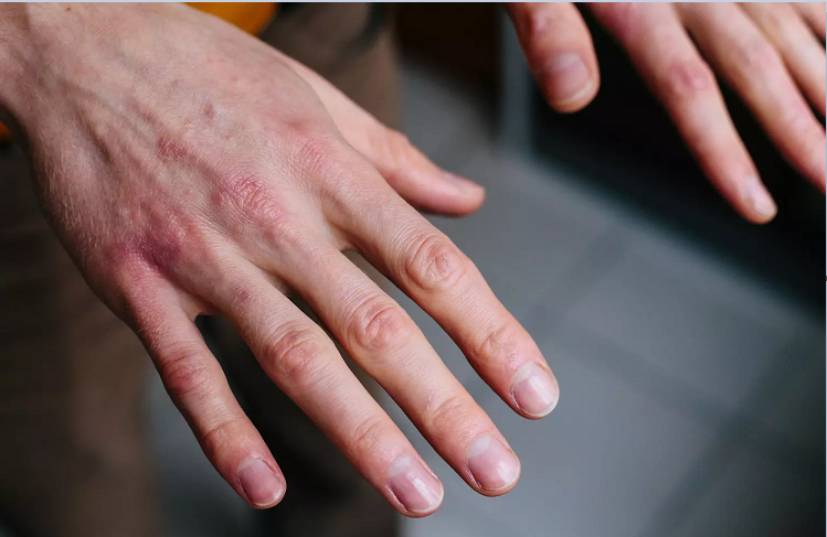 Comment apaiser les irritations de peau avec une astuce naturelle ?